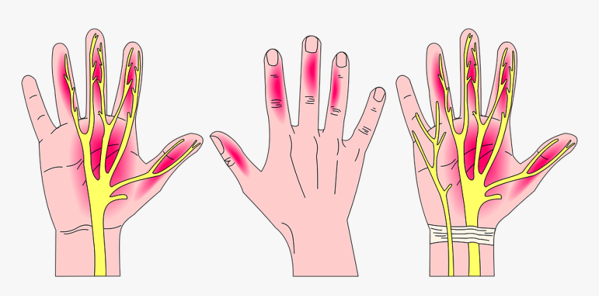 Carpal Tunnel Syndrome, HD Png Download, Free Download