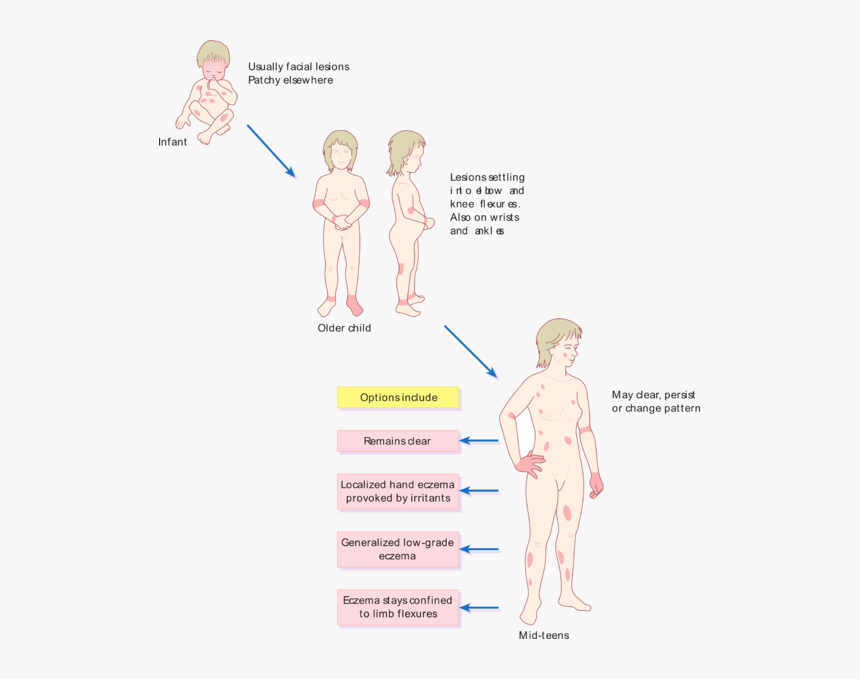 Pattern Of Atopic Eczema Varies With Age - Causes Itching All Over The Body, HD Png Download, Free Download