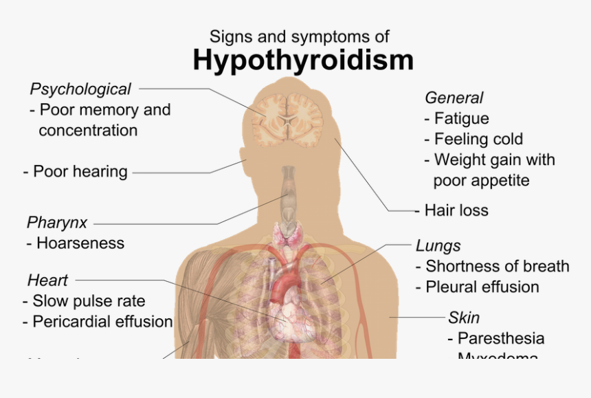 El hipotiroidismo es hereditario El hipotiroidismo es hereditario