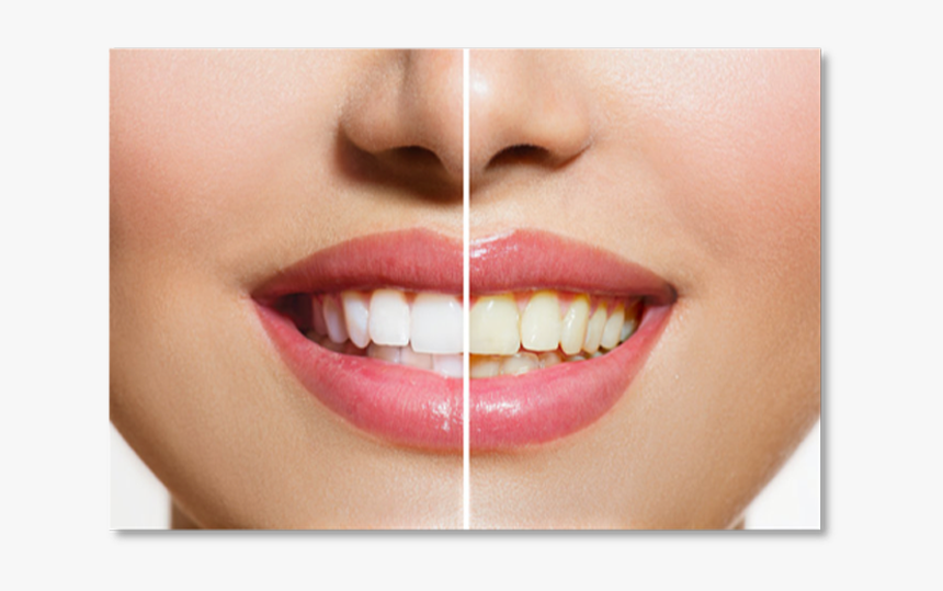 Dental Problems Before After, HD Png Download, Free Download