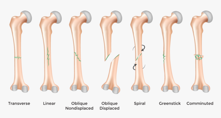 "bone Fracture - Comminuted Fracture Description, HD Png Download, Free Download