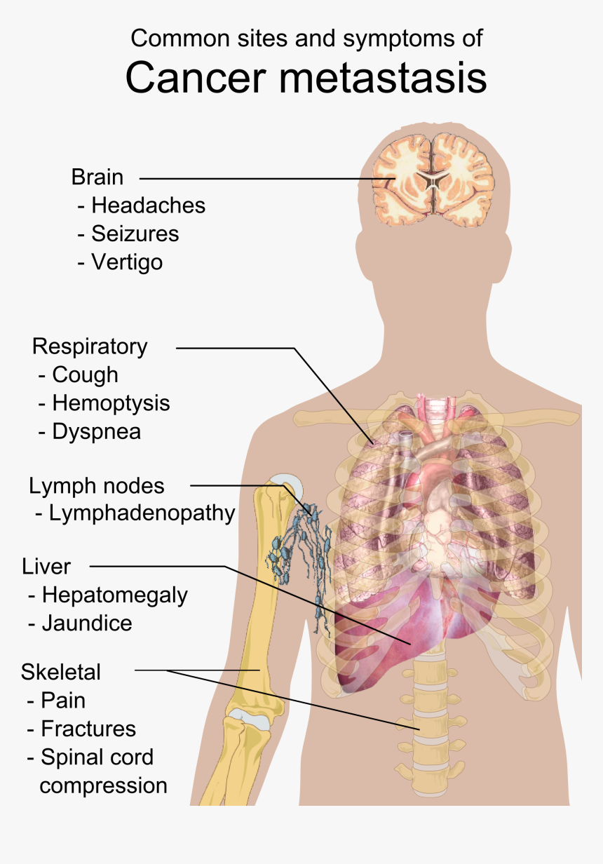 Symptoms Of Cancer Metastasis - Cancer Metastasis, HD Png Download, Free Download