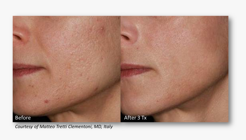 Before/after With Lutronic Infini - Before And After Infini Radiofrequency Microneedling, HD Png Download, Free Download