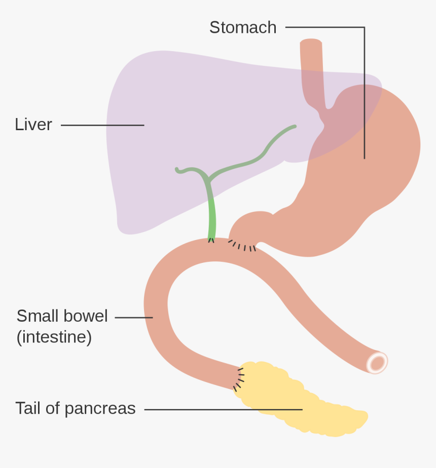 Pancreaticoduodenectomy, HD Png Download, Free Download