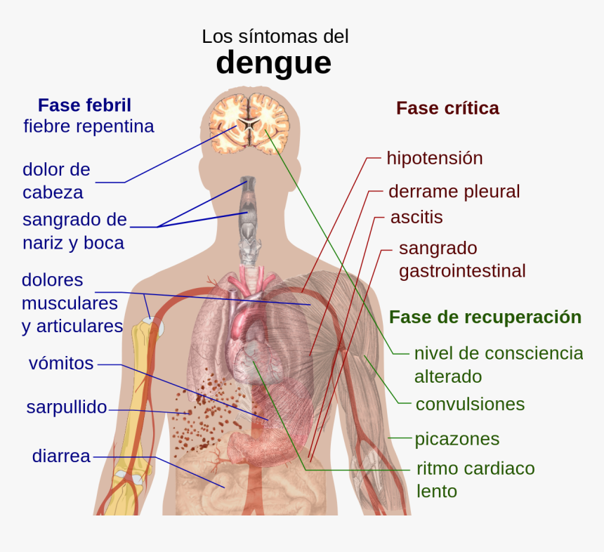 Symptoms Of Dengue Mosquito Bite, HD Png Download, Free Download