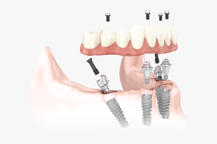 Model Drawing Of All On Four Dental Implants And Components - All On Four Transparent, HD Png Download, Free Download