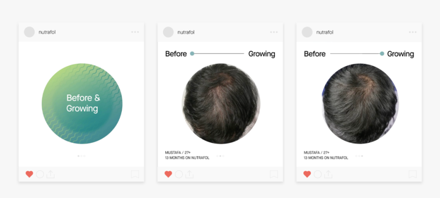 Developed An Instagram Template For Nutrafol’s “before - Lace Wig, HD Png Download, Free Download