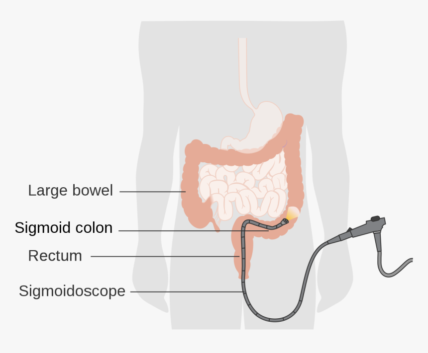 First Sign Of Colon Cancer, HD Png Download, Free Download