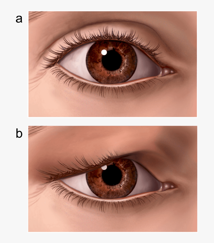 Illustration Showing A Normal Eyelid And Sagging Eyelid - Ptosis Eye Surgery, HD Png Download, Free Download
