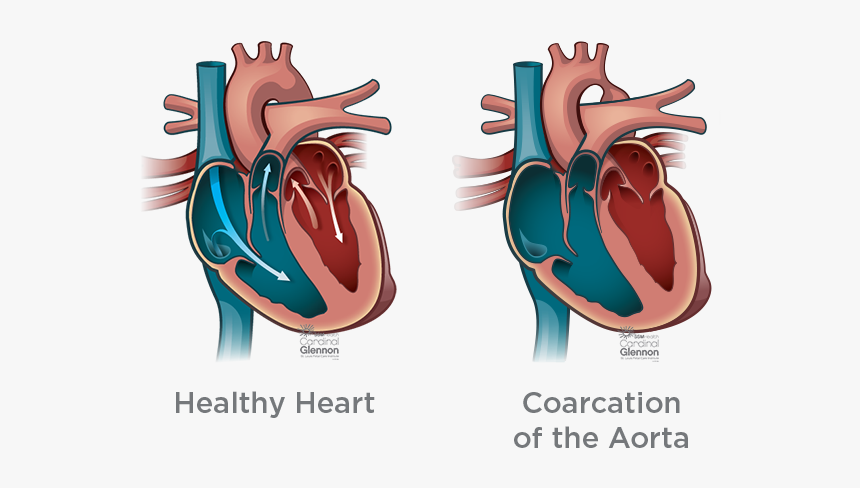 Coarcation-aorta - Ventricular Septal Defect, HD Png Download, Free Download