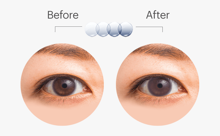 Oasys Transition Eyediagram - Acuvue Oasys With Transitions, HD Png Download, Free Download