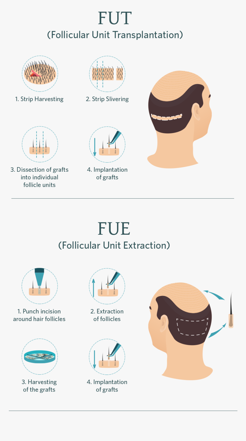 Treatment Surgical Hairrestoration Mob, HD Png Download, Free Download