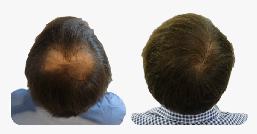 Fue Hair Transplant Scalp, HD Png Download, Free Download