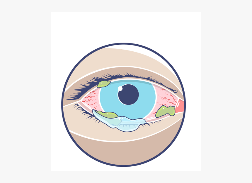 Eye Infection - Circle, HD Png Download, Free Download
