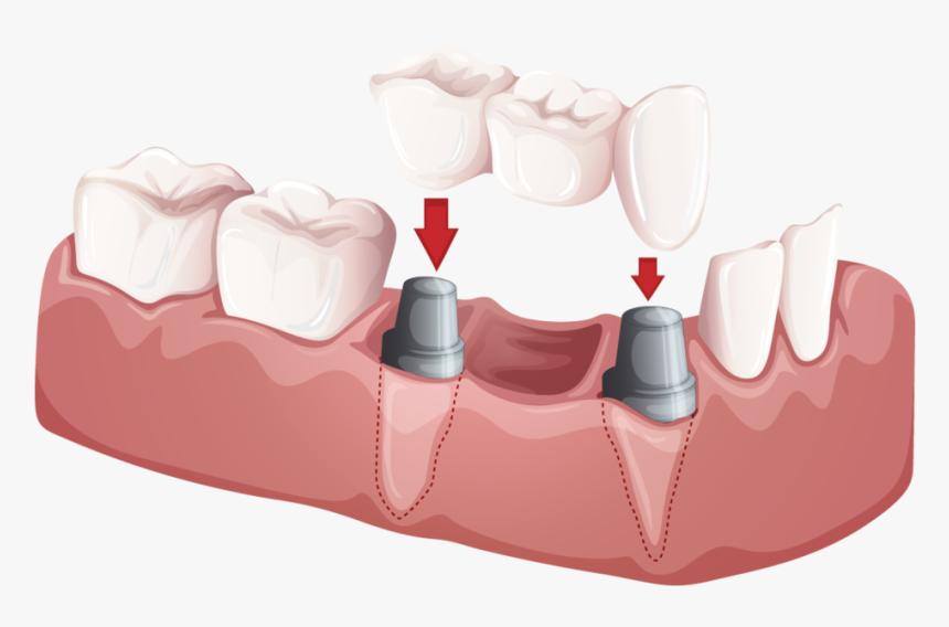 Crowns & Bridges, HD Png Download, Free Download