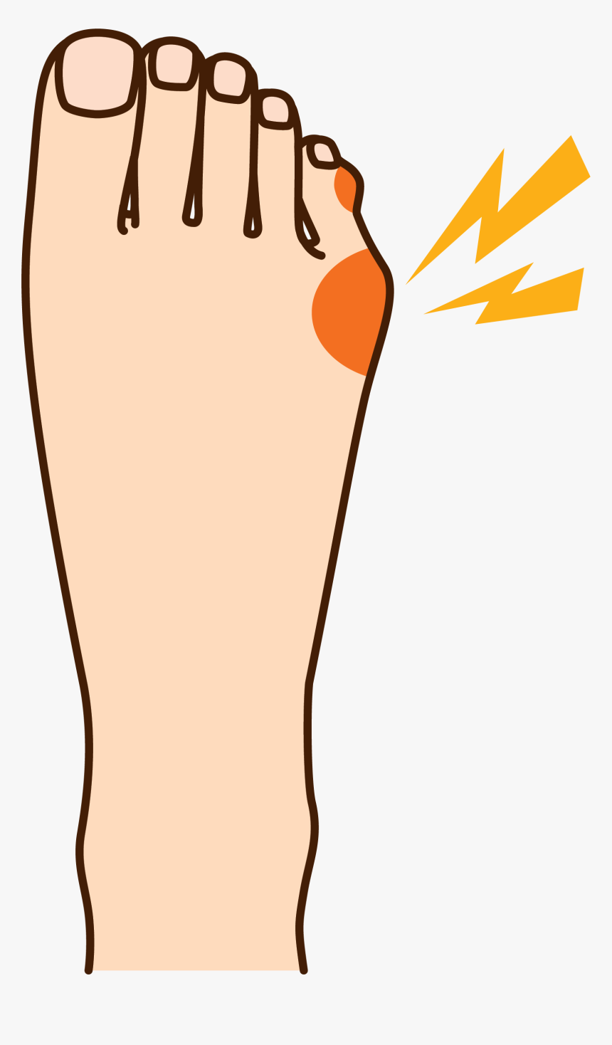How To Relieve Your Tailor"s Bunion Pain - Bunionette On Pinky Toe, HD Png Download, Free Download