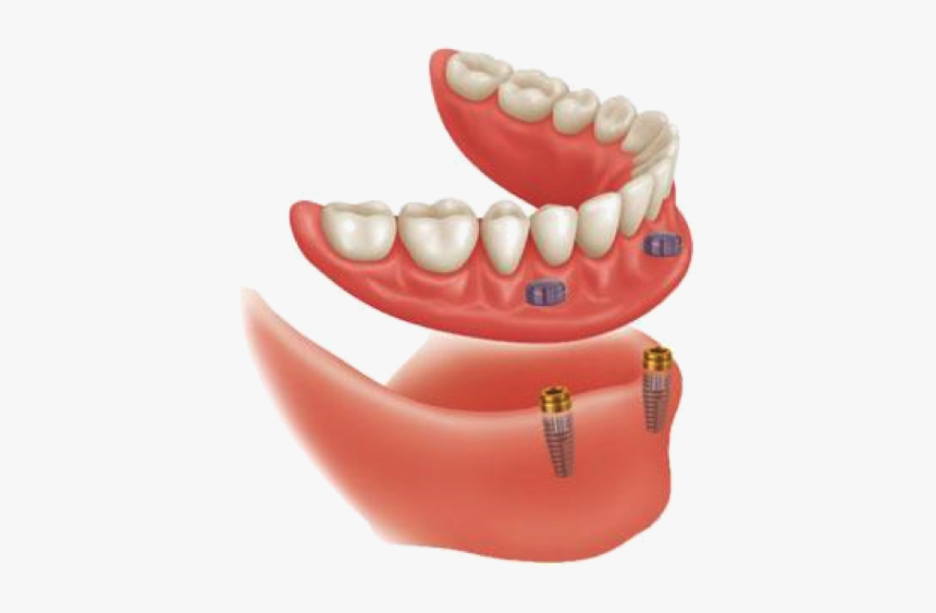 Implant Supported Dentures, HD Png Download, Free Download
