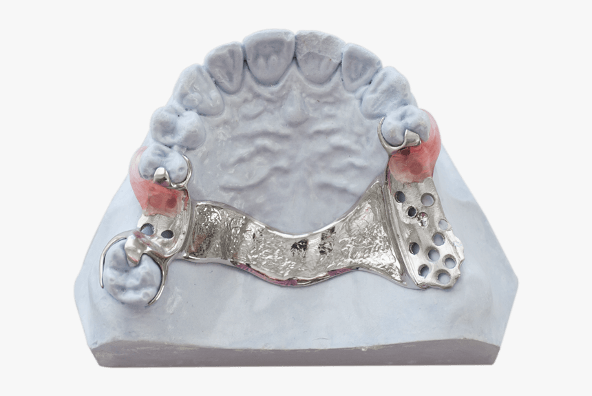 Partial Denture Hybrid Framework - Cast Metal Partial Denture, HD Png Download, Free Download