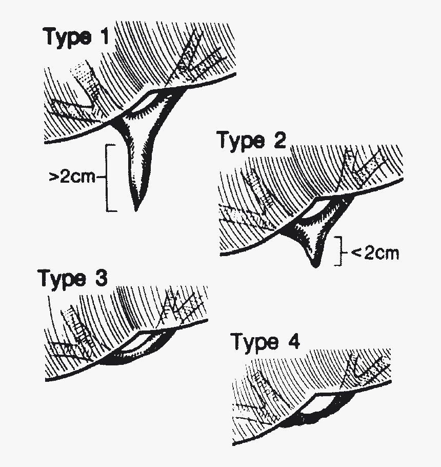 Bismuth Bile Duct Injury Classification, HD Png Download, Free Download