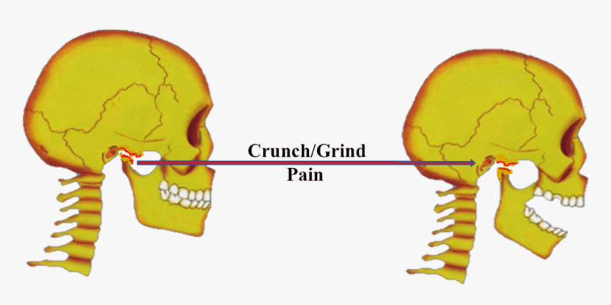 Tmj Jaw Joint Degenerative Joint Diseases - Osteoarthritis, HD Png Download, Free Download