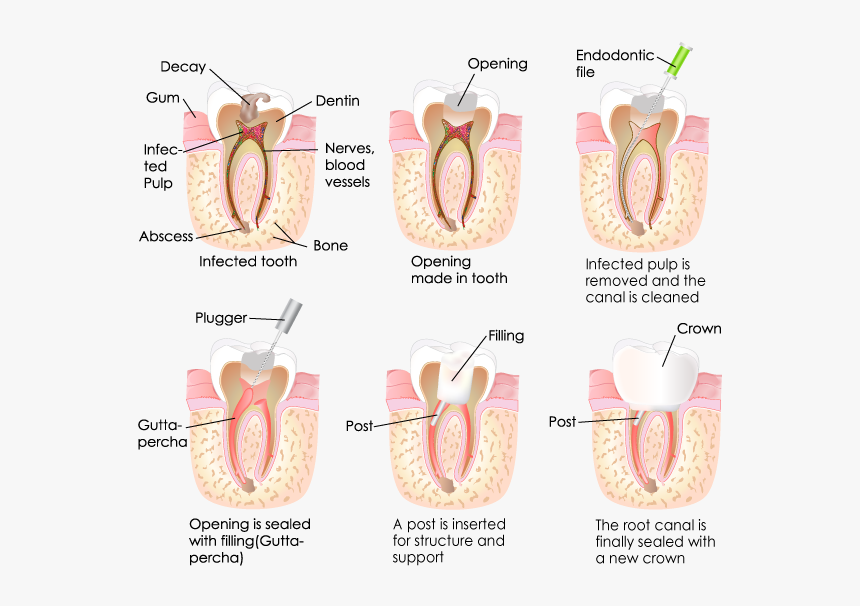 Root Canal Treatment, HD Png Download, Free Download