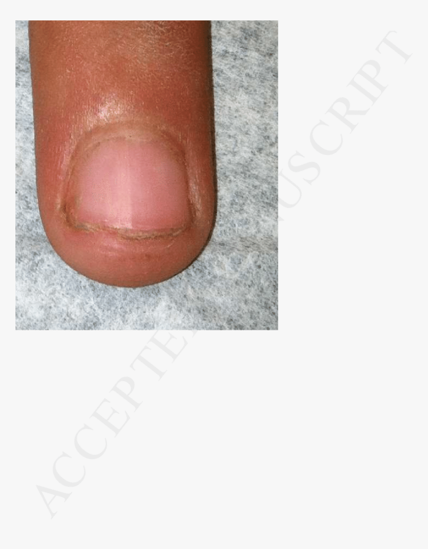 A Photo Of The Patient"s Fingernails, Demonstrating - Leather, HD Png Download, Free Download