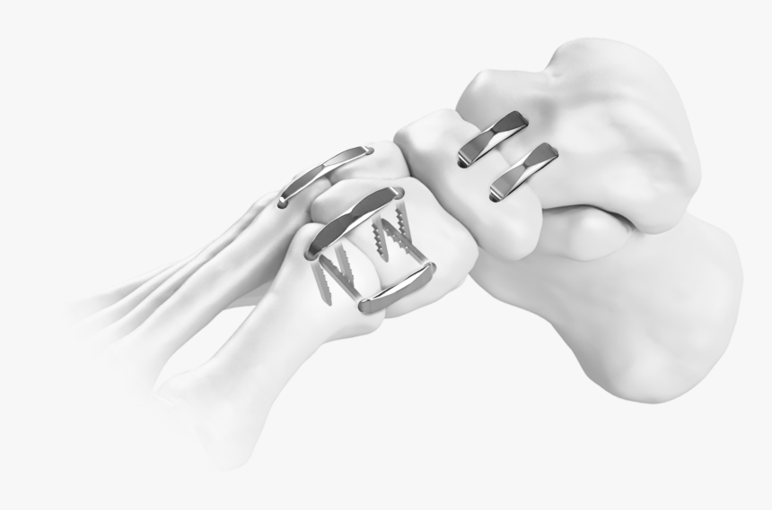 Hallux Valgus Implants, HD Png Download, Free Download