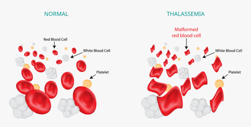 Thalassemia Disease, HD Png Download, Free Download