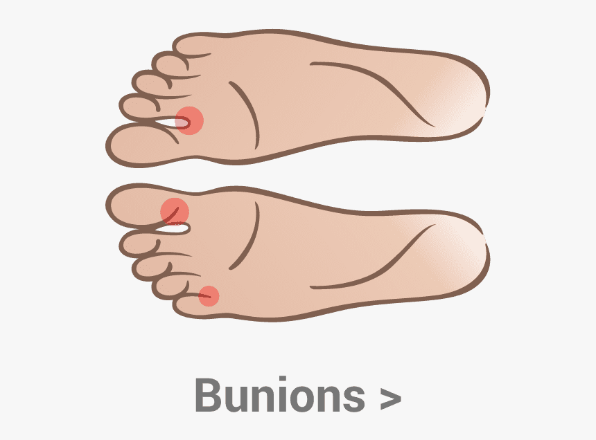 Bunions - Bump Under Big Toe Joint, HD Png Download, Free Download