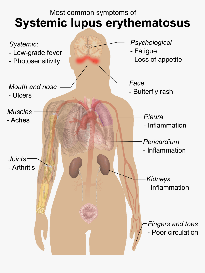 Symptoms Of Sle - Systemic Lupus Erythematosus, HD Png Download, Free Download