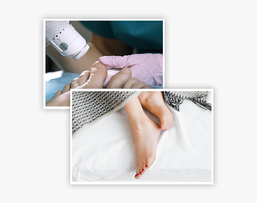 Laser Skin Resurfacing On Feet, HD Png Download, Free Download