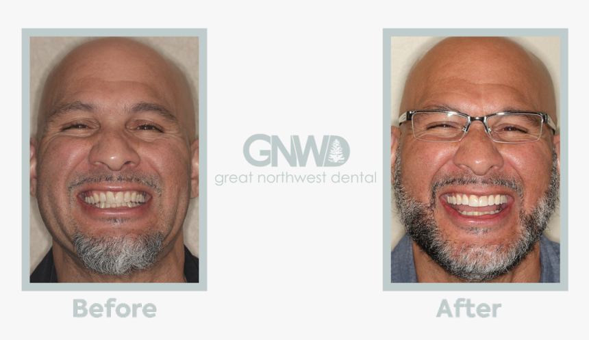 Emery - Invisalign Before And After Wdult, HD Png Download, Free Download