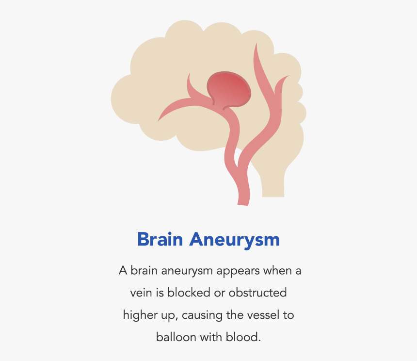 Brain Aneurysm, What Is A Brain Aneurysm - Causes Brain Aneurysm, HD Png Download, Free Download