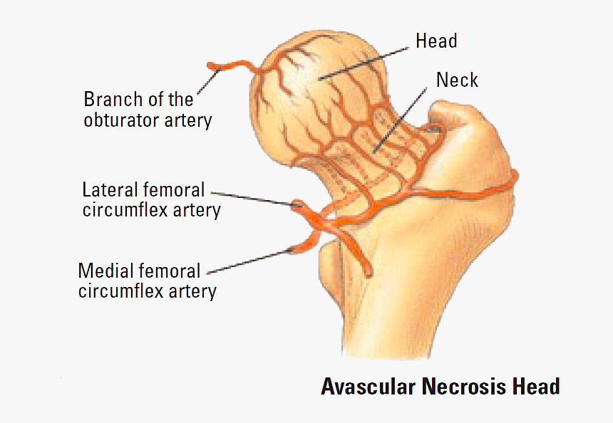Ligamentum Teres Artery Avascular Necrosis, HD Png Download, Free Download