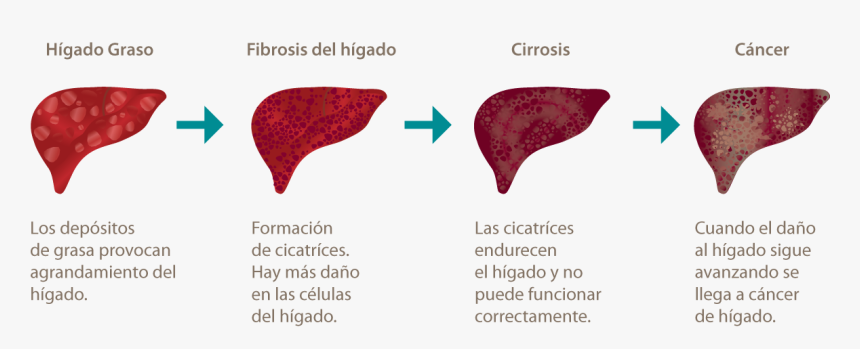 Alimentos para cancer de higado Alimentos para cancer de higado