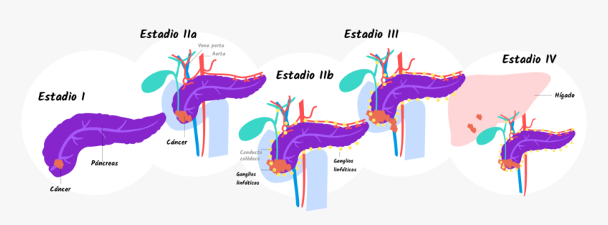 4 Stages Of Pancreatic Cancer, HD Png Download, Free Download