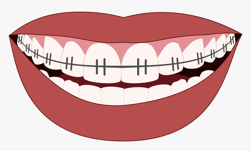 Braces Teeth Clipart Png, Transparent Png, Free Download