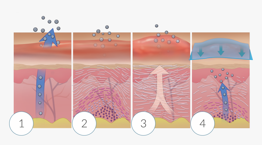 How Scars Are Formed And Healed - Illustration, HD Png Download, Free Download