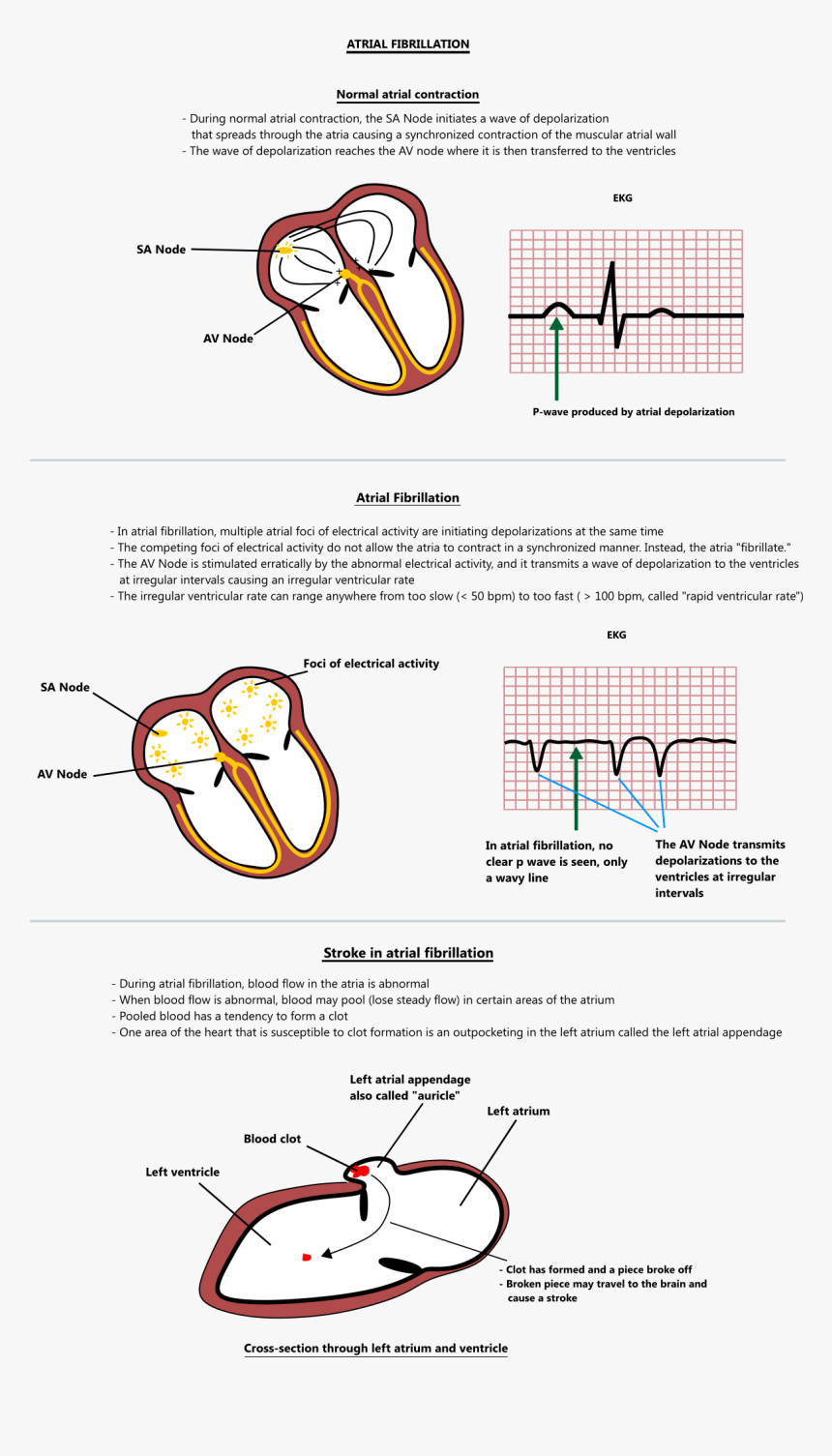 Atrial Fibrillation And Atrial Depolarization, HD Png Download - kindpng