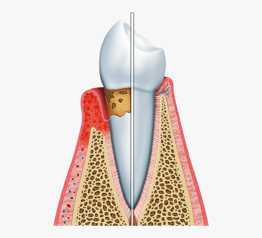 Gum Disease - Periodontal Png, Transparent Png, Free Download