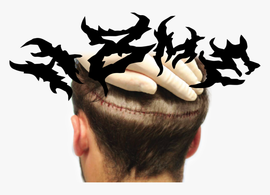 H8me Head Split Copy - Hair Transplant Scar, HD Png Download, Free Download