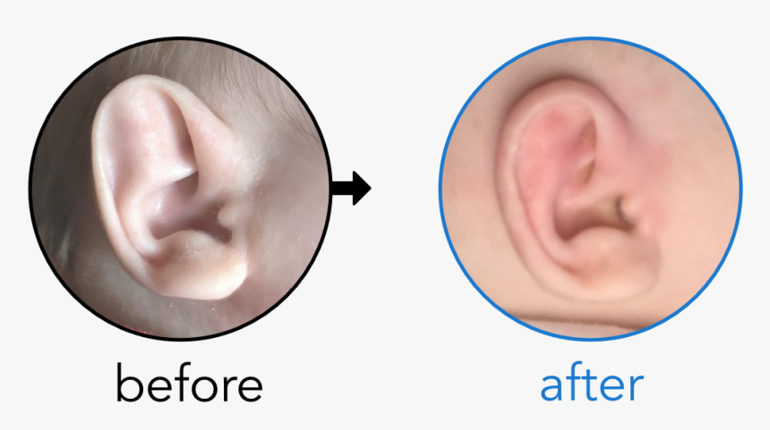 Baby"s Ear Folded Like An Elf Ear - My Baby Before After, HD Png Download, Free Download