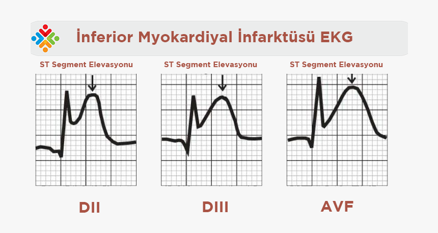 Myocardial Infarction Ekg After Heart Attack, HD Png Download, Free Download