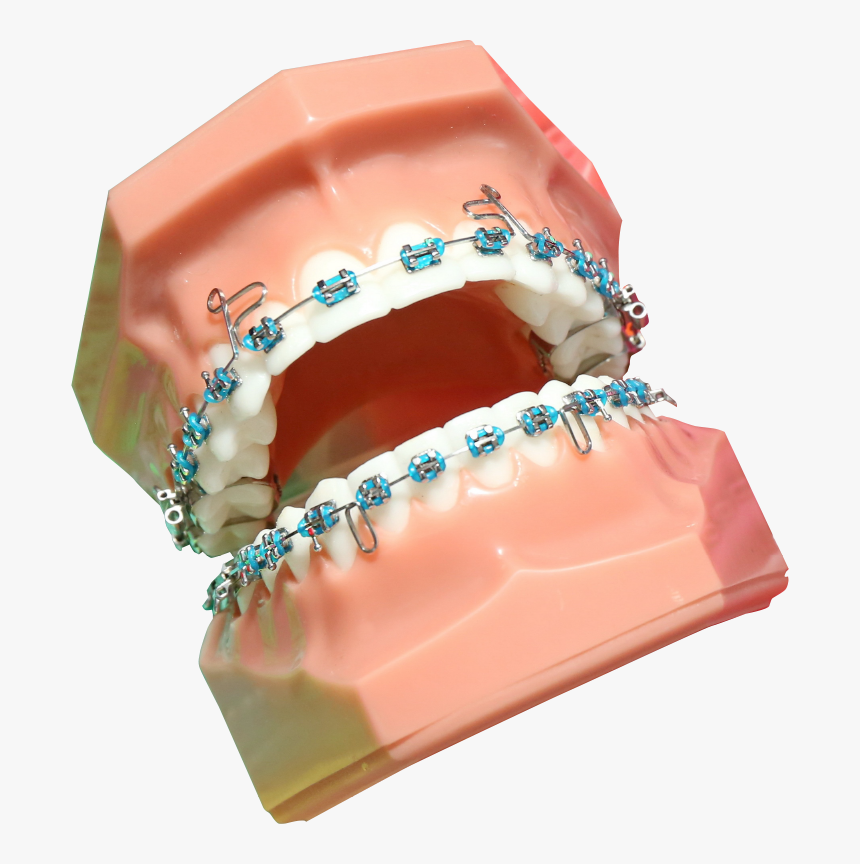 Transparent Braces Png - Rodzaje Aparatów Ortodontycznych Stałych, Png Download, Free Download