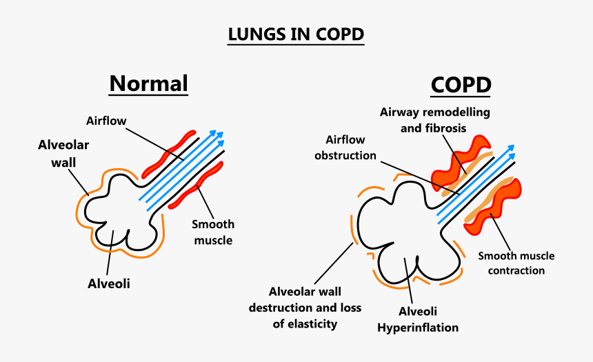 Alveoli Copd, HD Png Download, Free Download