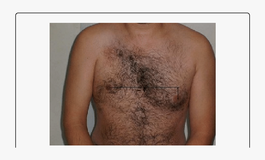 Pectoral Atrophy, HD Png Download, Free Download