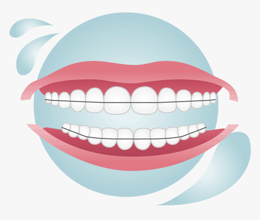 Metal Removable Orthodontic Retainer Covering A Set, HD Png Download, Free Download