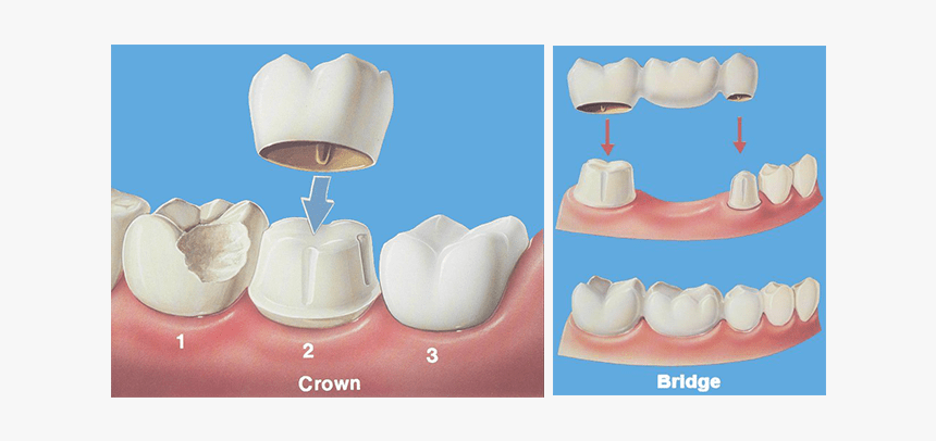 Crown Bridge Hobe Sound Dentist - Dental Crown And Bridge, HD Png Download, Free Download