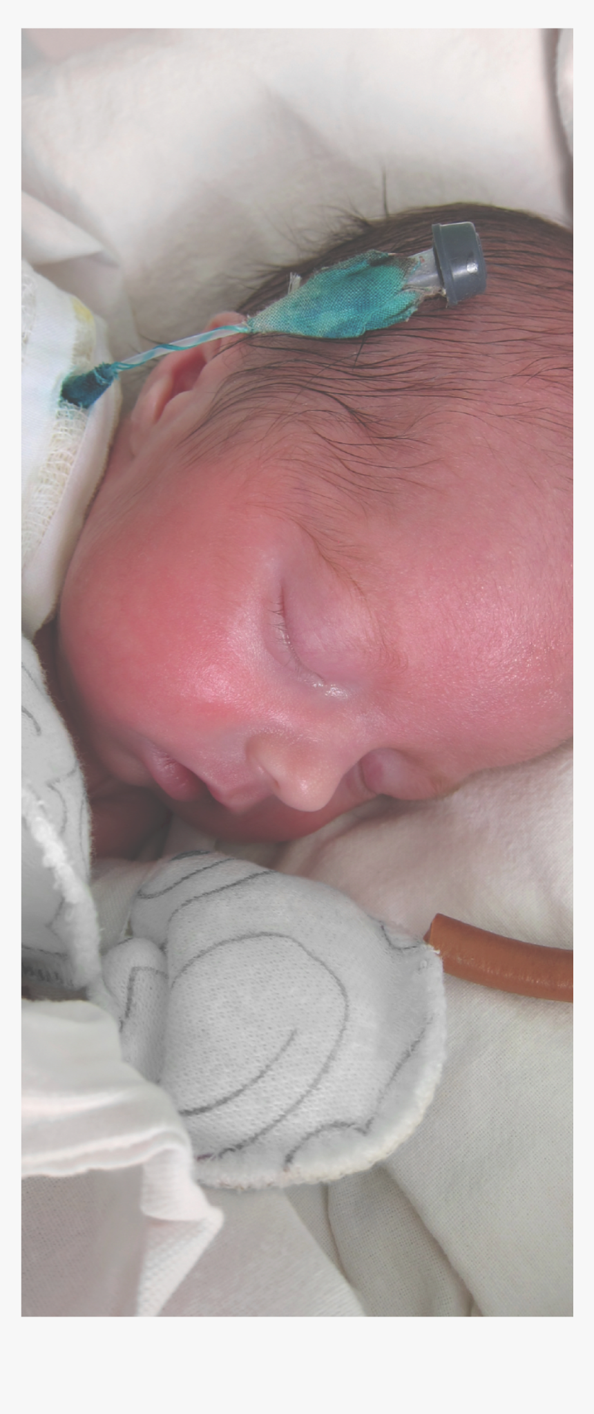 Newborn With A Cvc - Baby, HD Png Download, Free Download