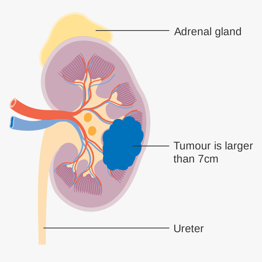 Kidney Cancer Diagram , Png Download - Illustration, Transparent Png, Free Download
